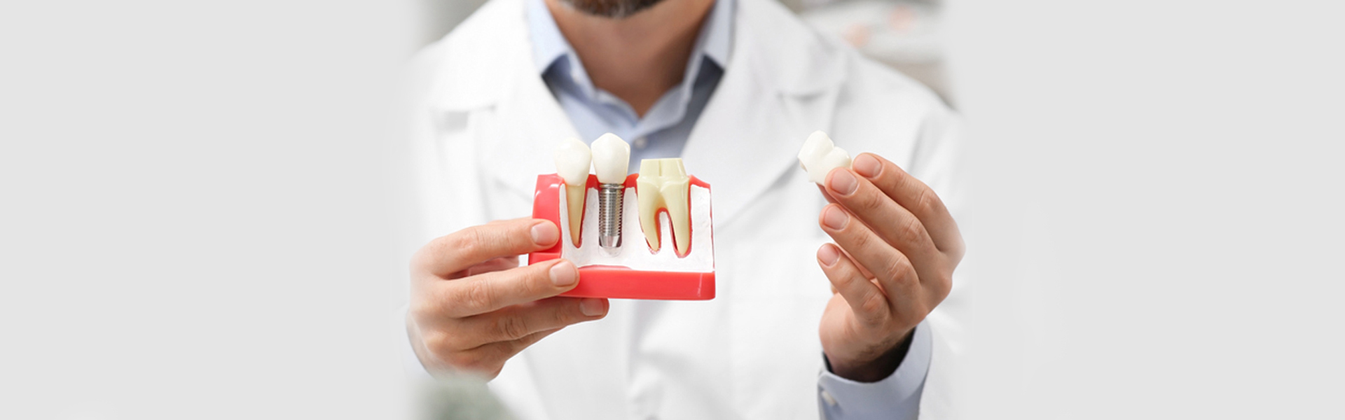 Is Dental Implant the Best Solution for Tooth Loss? Unveiling the Truth