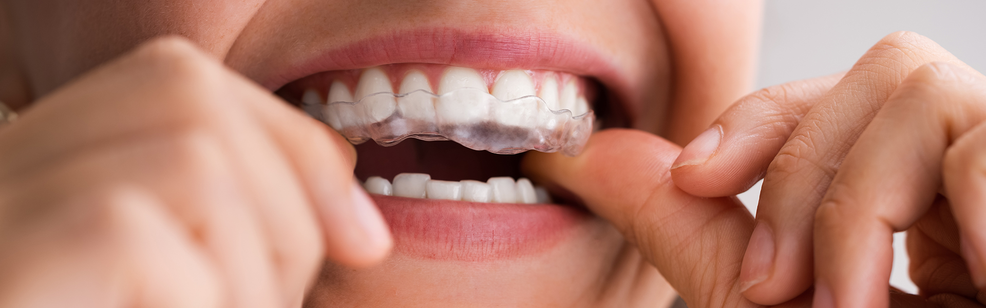 How Much Time Is Required to Get Comfortable with Invisalign?